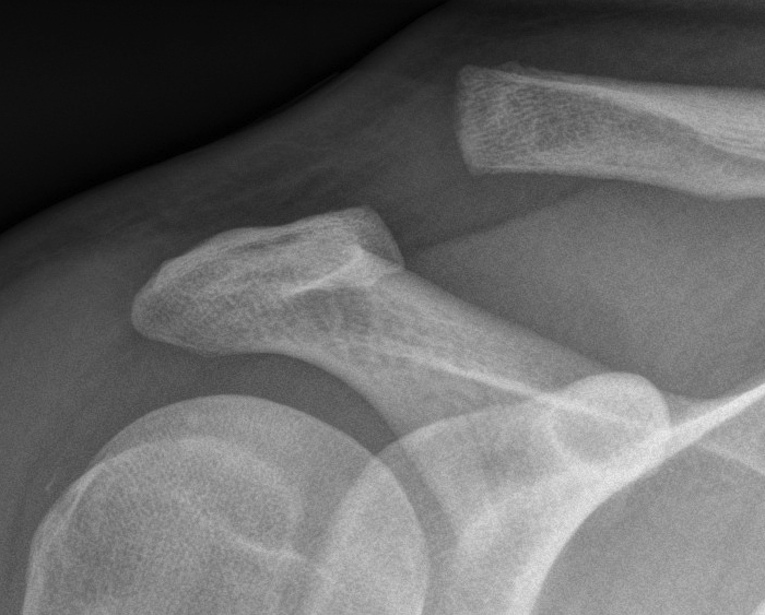 Type 3 ACJ Dislocation